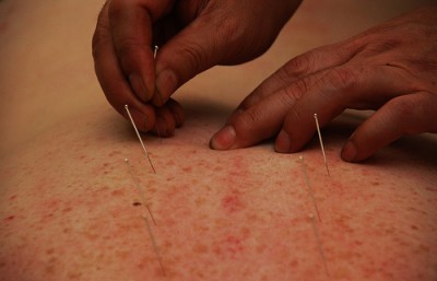Acupunctura, uma das terapêuticas não convencionais reconhecida pela lei de 2003 - Foto de Renato Ganoza / Flickr