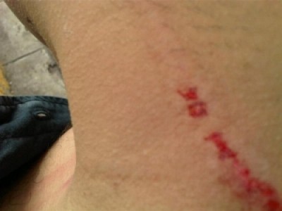  Foto do braço do jornalista agredido pelo Presidente do Marítimo. Foto DN-Madeira.