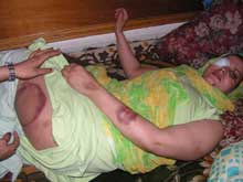 Estudante Sultana Khaya mostrando ferimentos foto de Blogue Sahara Livre