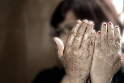 Vítima de violência doméstica mostra queimaduras nas mãos