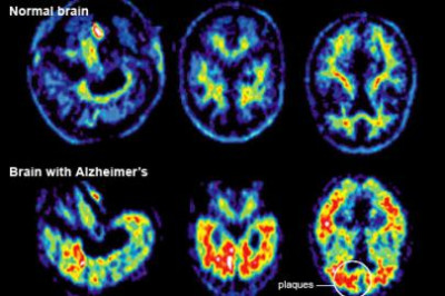 Imagem de cérebro normal e de cérebro com Alzheimer