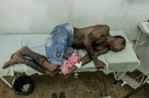 Indígena ferido recebendo em atendimento médico na cidade de Vitória do Mearim. Foto de Ana Mendes/Cimi