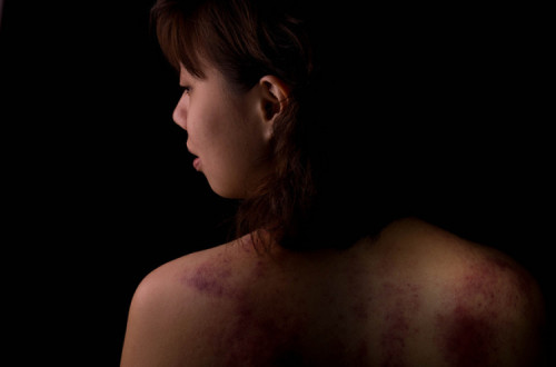 Vítima de violência doméstica.