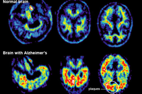 Imagem de cérebro normal e de cérebro com Alzheimer